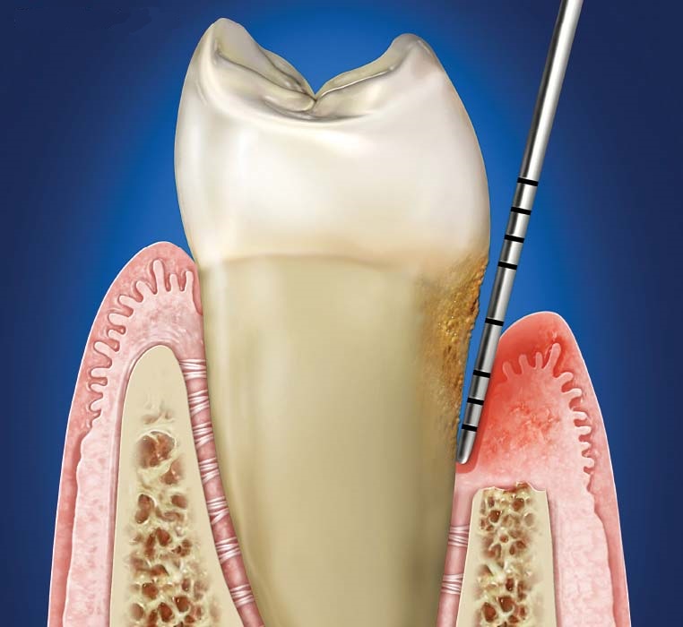 periodontitt-tannlege-jostein-andersen-spesialist-i-periodonti